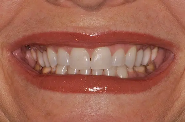 After Veneers