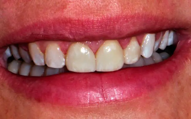 After Esthetic Veneers