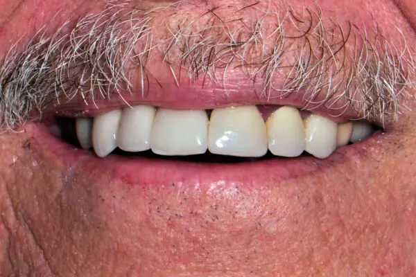 After Implant Bridge