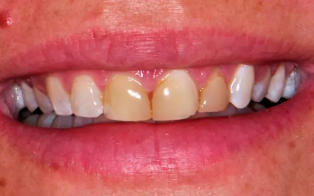 Before Esthetic Veneers